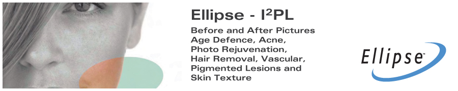 Ellipse IPL Permanent Hair Reduction